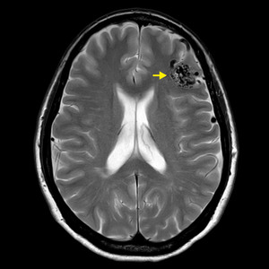 AVM-Frontallappen-MRI-Bild