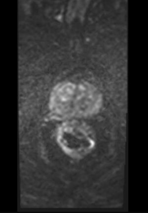 BPH Prostata Diffusion