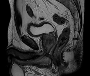 BPH Prostata T2