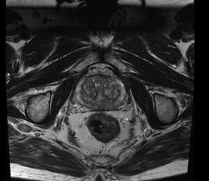 BPH Prostata T2  2