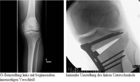Beinfehlstellungen