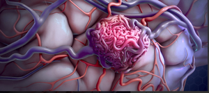 2024-12-04 18_07_26-Brain Arteriovenous Malformation (AVM) -