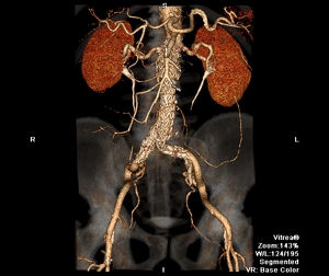 CTA_aorta_0000_0006_28408_76212