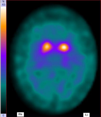 DaTSCAN bei Parkinson-Erkrankung