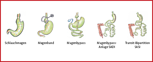 OP Verfahren der Adipositaschirurgie