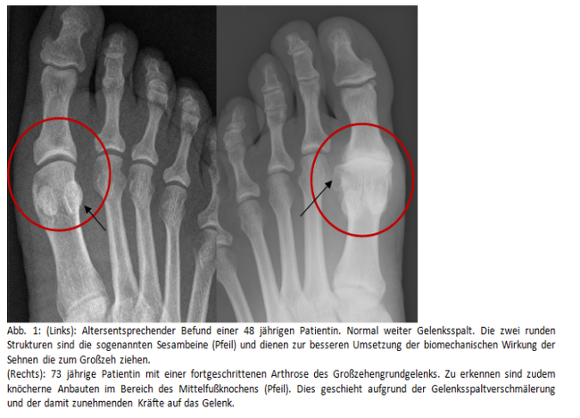 Hallux_rigidus_75709