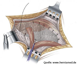 Hernioplastik_Lichtenstein