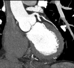 Herz CT Stenose MIP2
