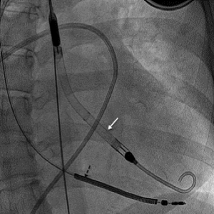 Herzpumpe_Impella_UKB_Bochum