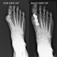 Roentgenbild GGG Arthrodese