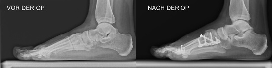 Roentgenbild Lapidus-Arthrodese 2
