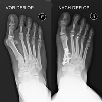 Roentgenbild Lapidus-Arthrodese