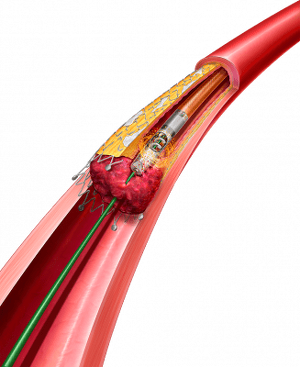 Rotarex-Instent-Restenosis-1-Layers_mod_small-327x400