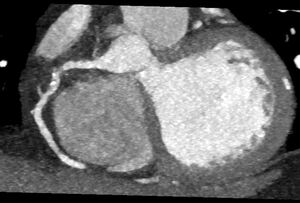 Subtotale Stenose RCA
