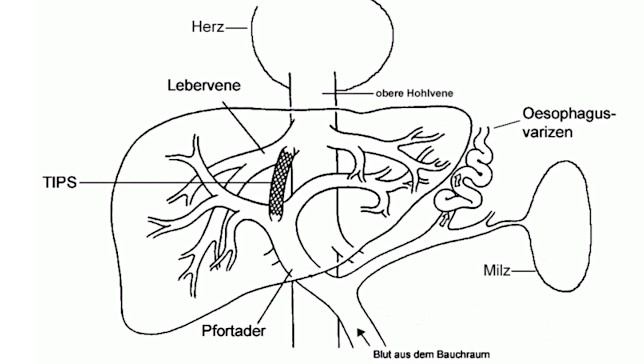 TIPS_Zeichnung_76217