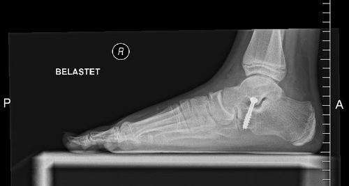 Talus-Stoppschraube
