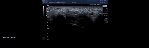 Video Ultraschall der Hirngefaeße