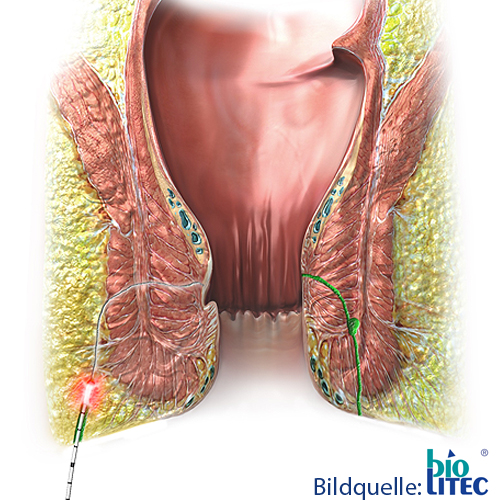 Animation einer Laserbehandlung