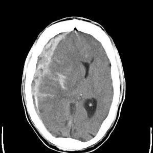 bild_1_schaedelhirntrauma1_13509