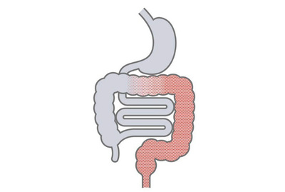 colitis-ulcerosa-darm