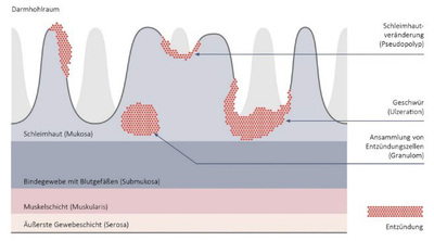 colitis-ulcerosa-darmwand