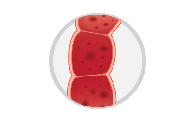 colitis-ulcerosa-darmwand