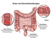 divertikel_44705