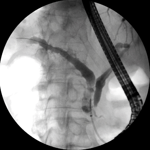 Darstellung des Bauchspeicheldrüsenganges