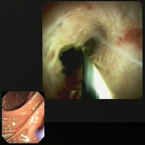 Pankreaticographie und direkte Endoskopie – Pancreaticoskopie