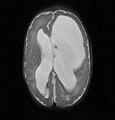 hydrozephalus