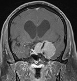 tumor